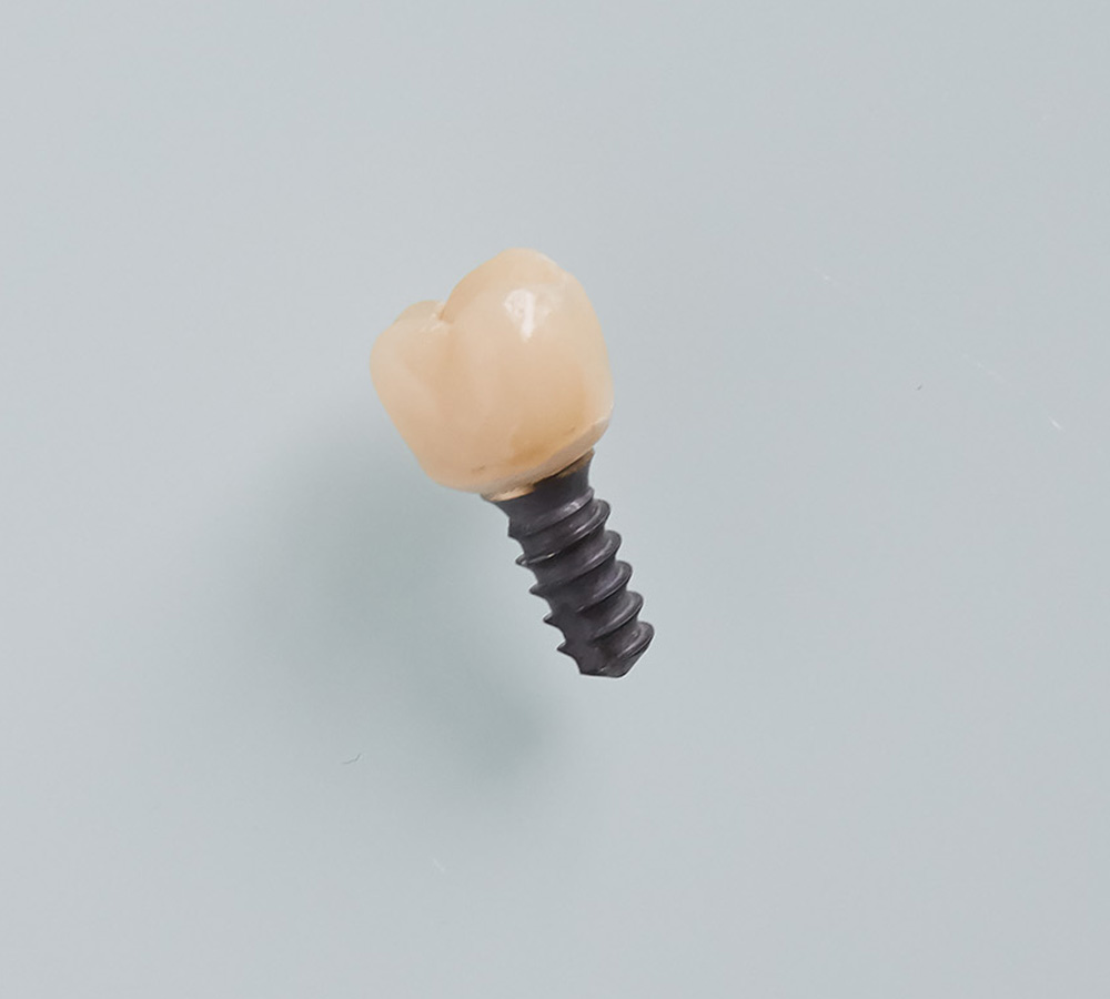 Keramikimplantat-Hamburg-Titanimplantat